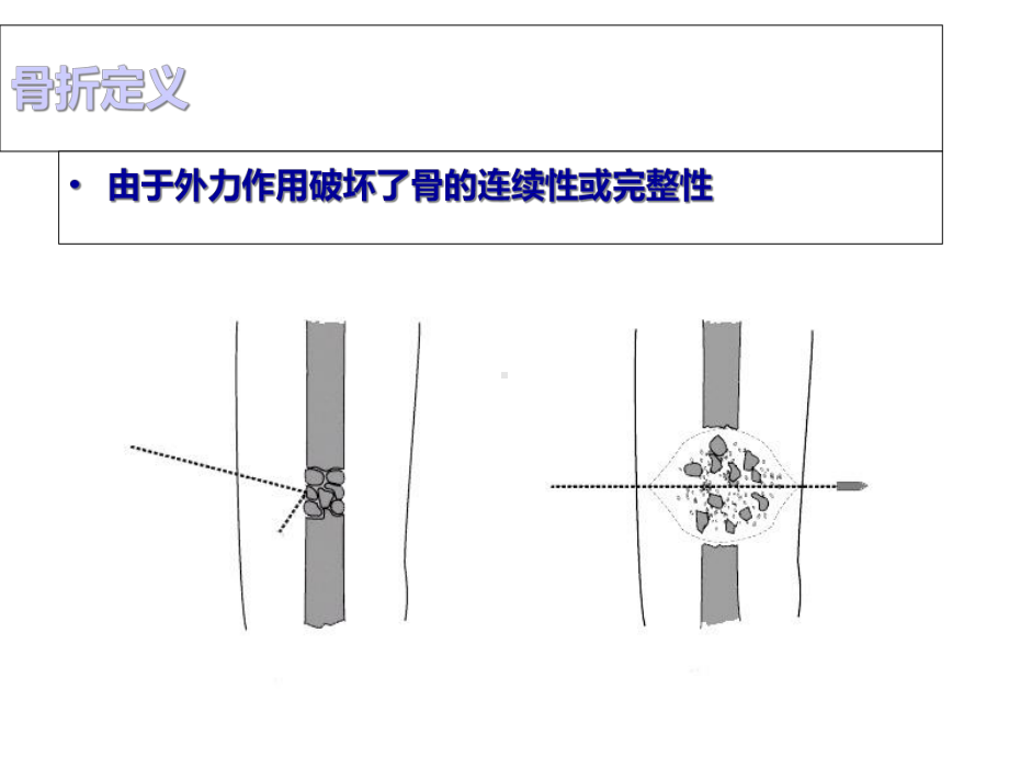 b骨折概论-课件.ppt_第2页