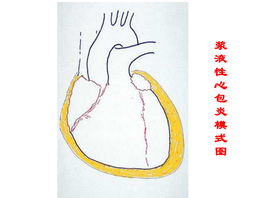 第8版内科学课件心包积液及心脏压塞共27p.ppt_第3页