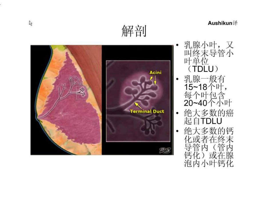 乳腺钙化课件.ppt_第2页