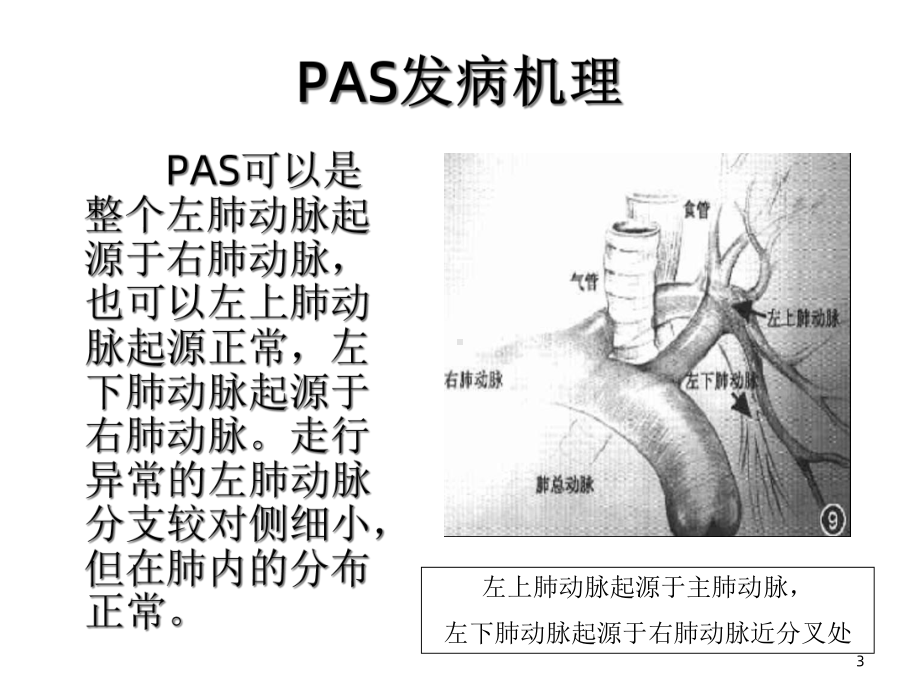 肺动脉吊带的影像学表现课件.ppt_第3页