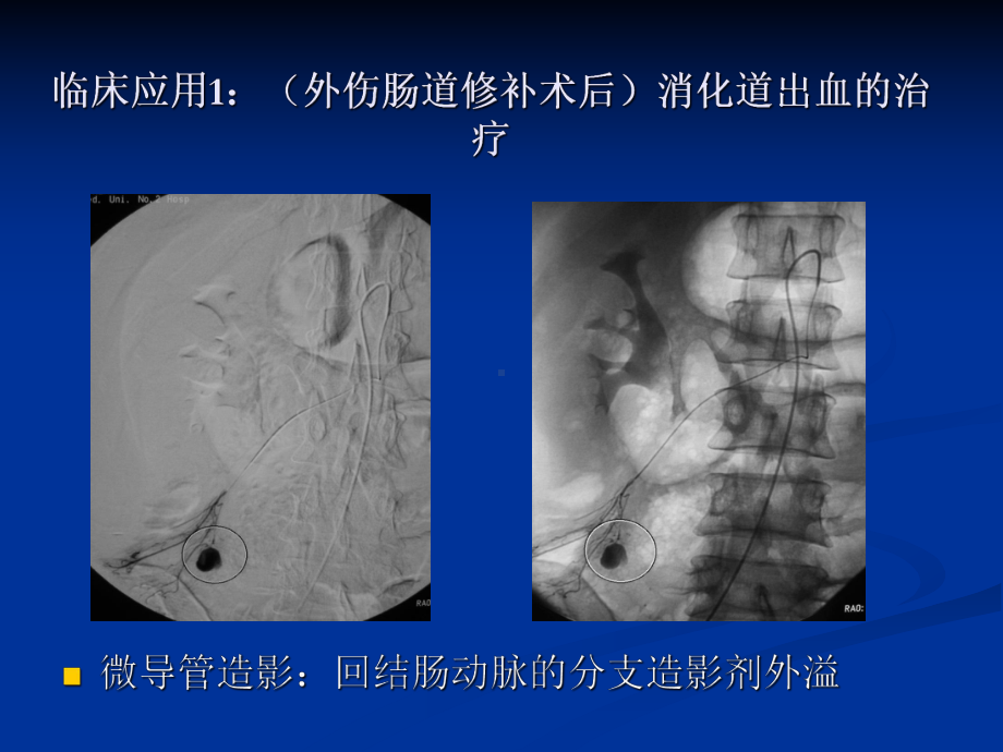 急性动脉性出血的介入治疗课件.ppt_第2页