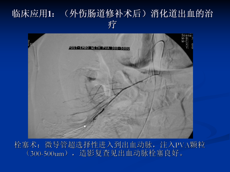 急性动脉性出血的介入治疗课件.ppt_第3页