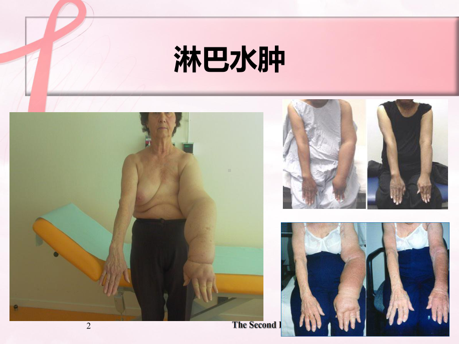 乳腺癌术后淋巴水肿康复治疗课件医学.ppt_第2页