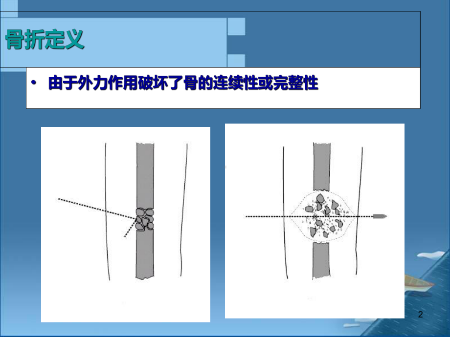 b骨折概论课件.ppt_第2页