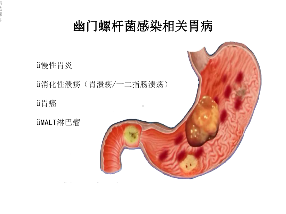 碳呼气试验检测幽门螺杆菌课件.ppt_第3页