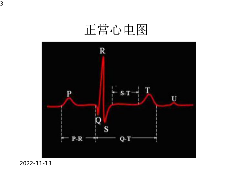 《心电图危急值》课件.pptx_第3页