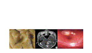 神经系统囊虫病的诊断和治疗课件.ppt
