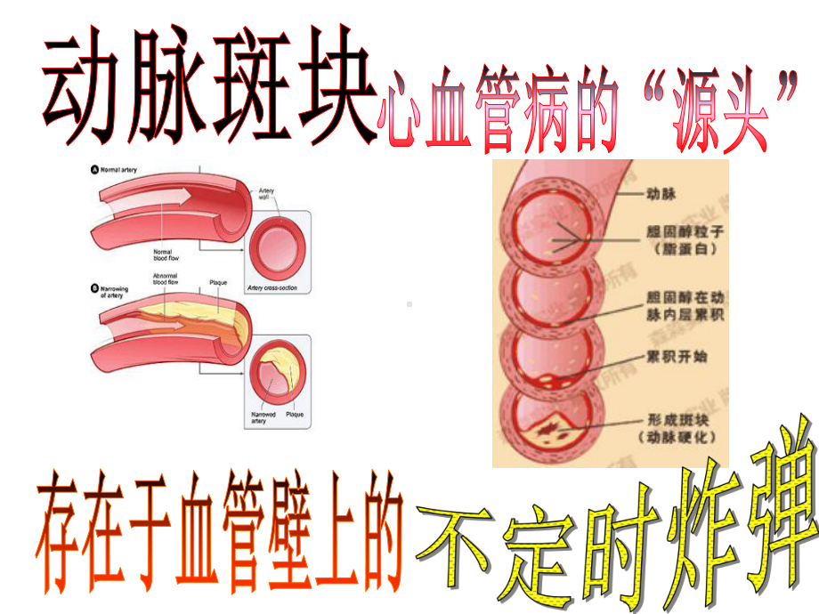 颈动脉斑块专题课件.ppt_第1页