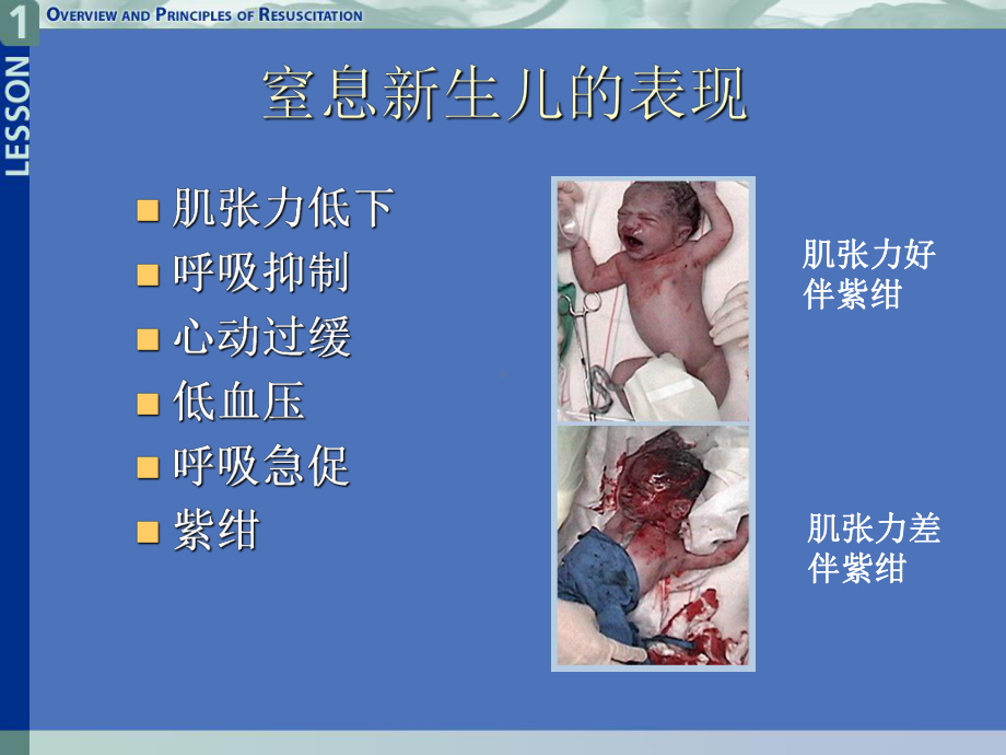 新生儿窒息指南课件.ppt_第3页