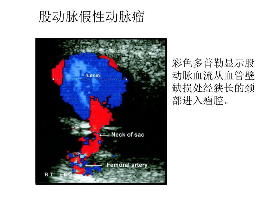 pci的并发症-课件.ppt_第3页