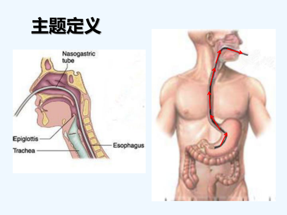 提高患者胃肠减压期间舒适度(ppt).ppt_第3页