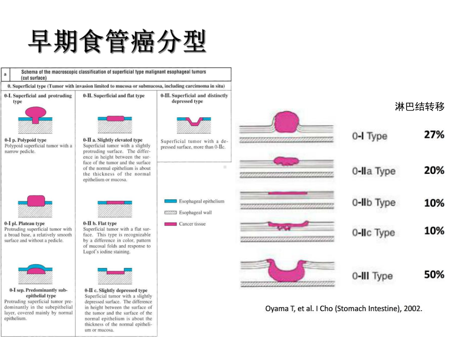 NBI+放大在食管早癌诊断中的应用进展-医学精品.ppt_第3页