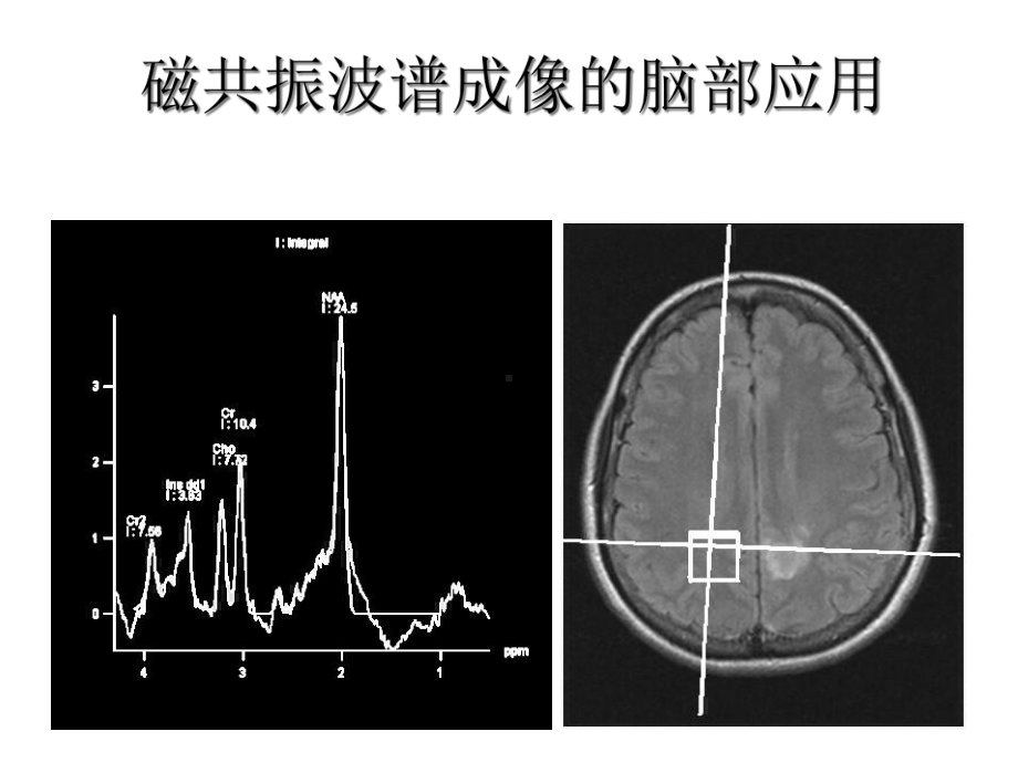 磁共振波谱成像的脑部应用课件.ppt_第1页