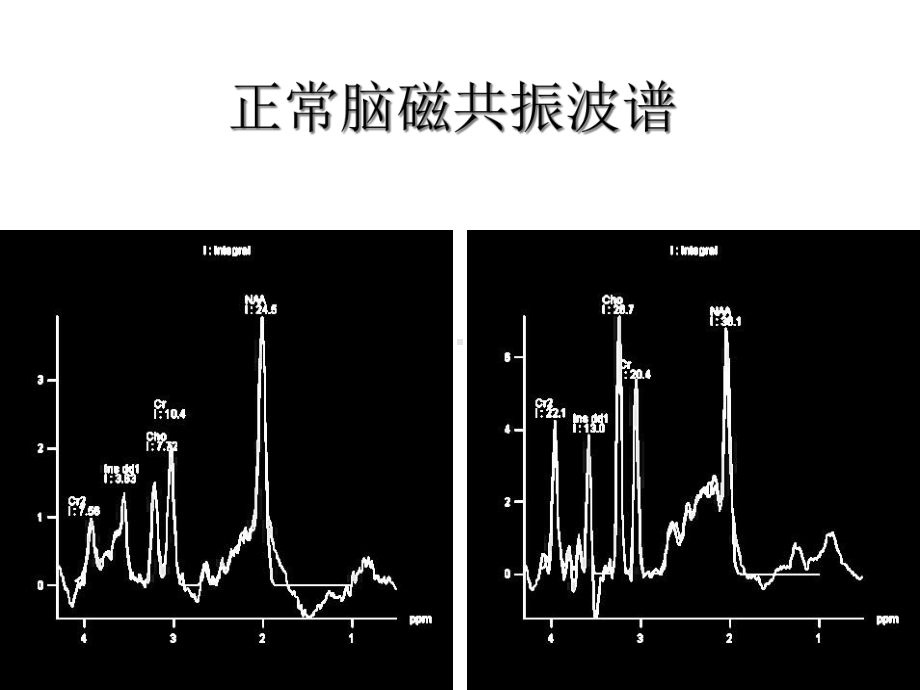 磁共振波谱成像的脑部应用课件.ppt_第3页