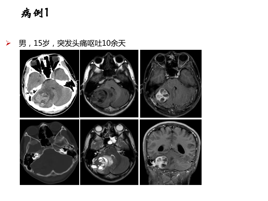 颅骨肿瘤影像学表现课件.ppt_第2页