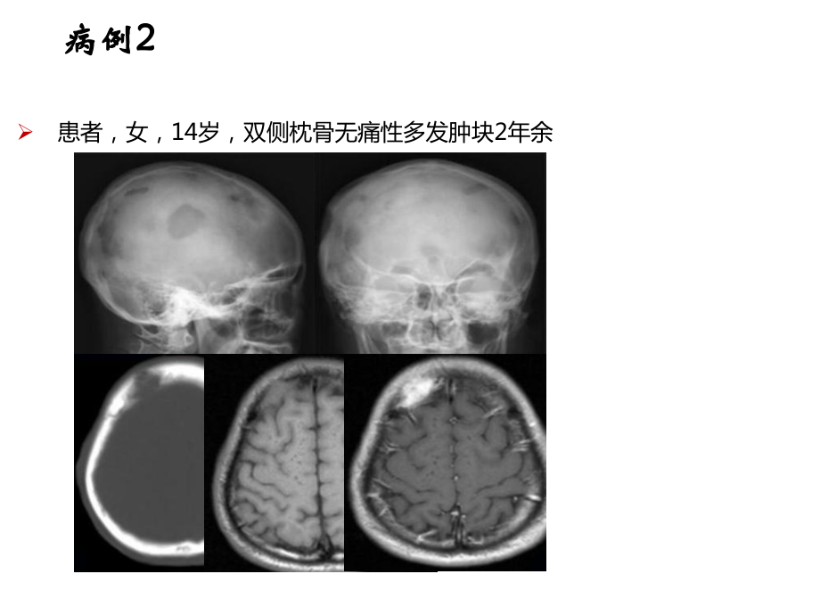 颅骨肿瘤影像学表现课件.ppt_第3页