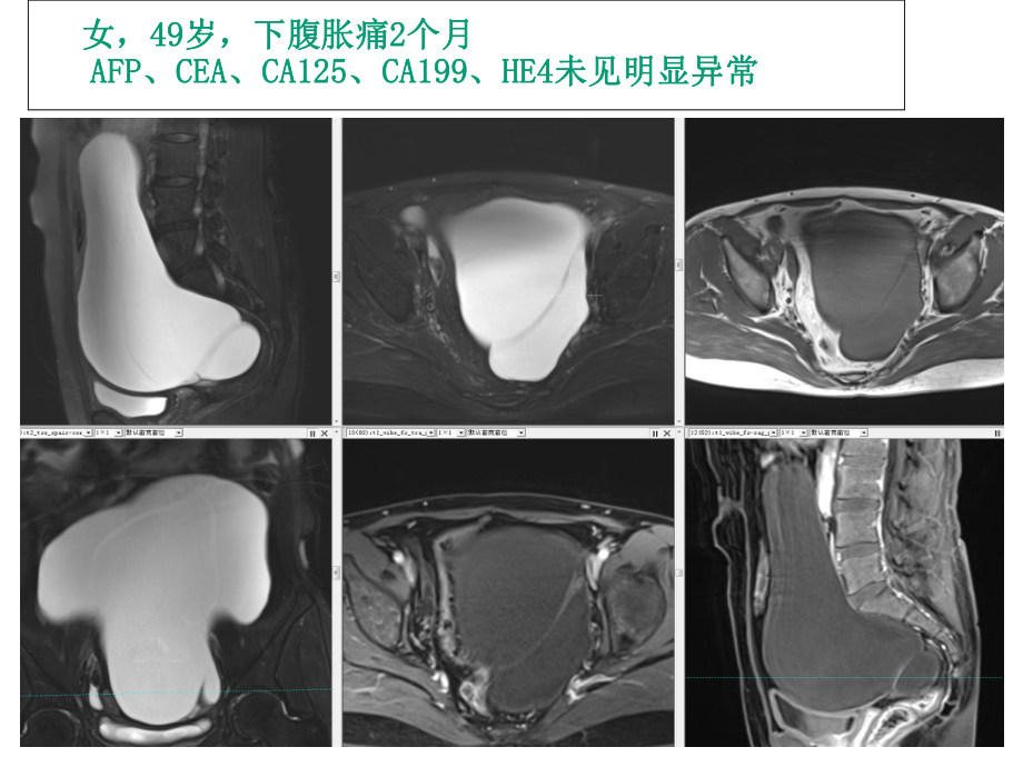 卵巢常见病变MR诊断.ppt_第2页