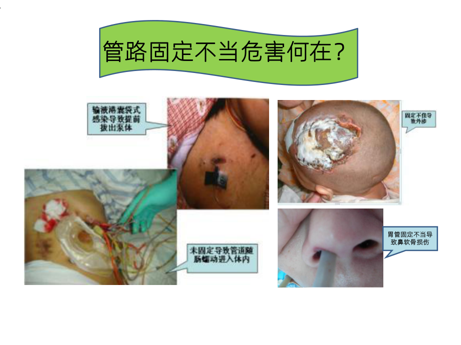 《危重患者管路固定》课件.ppt_第2页