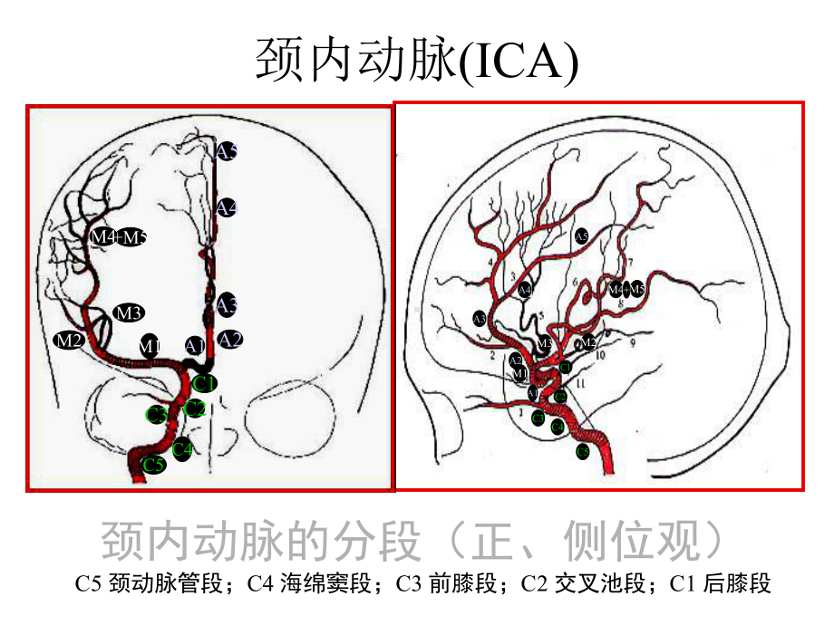 颈内动脉海绵窦瘘讲课完整版课件.pptx_第3页