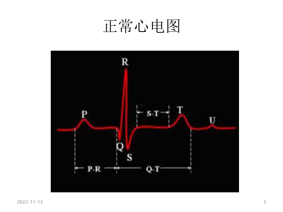 《心电图危急值》课件2.pptx_第3页