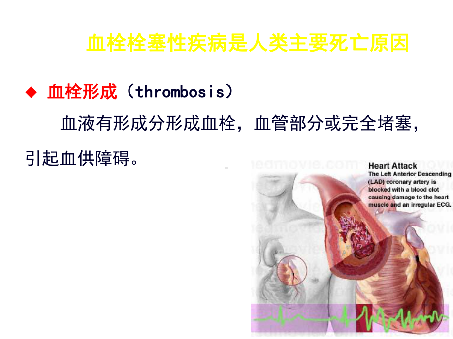 心血管疾病的溶栓抗栓治疗.ppt_第2页