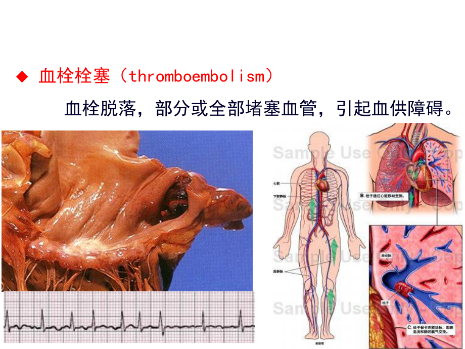 心血管疾病的溶栓抗栓治疗.ppt_第3页