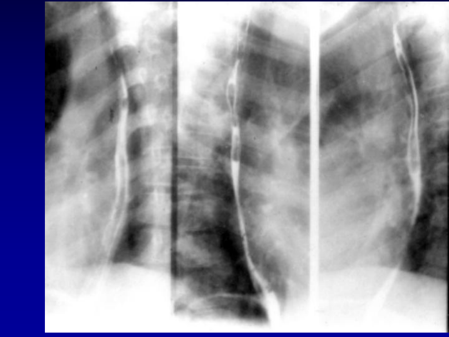 消化系统X射线憩室（课件）.ppt_第3页