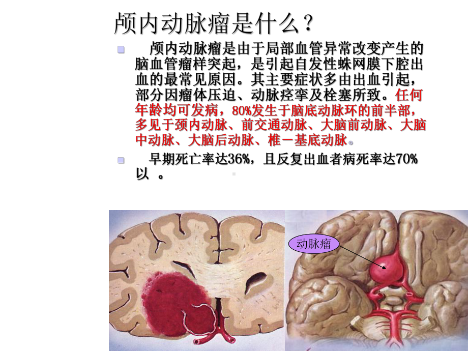 颅内动脉瘤(共22张)课件.pptx_第2页