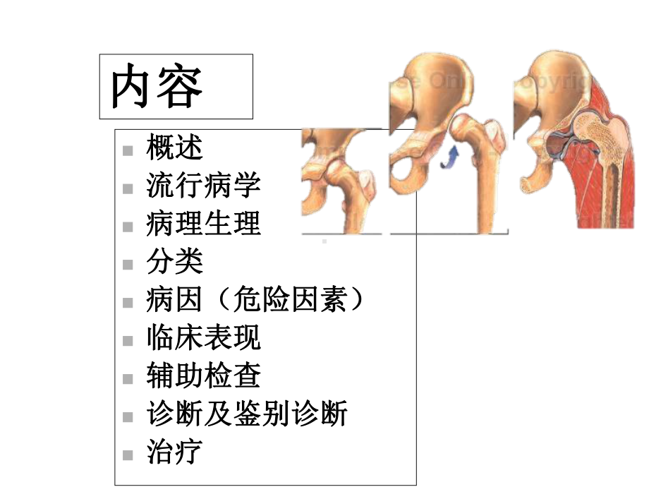 发育性髋关节发育不良髋脱位.ppt_第2页