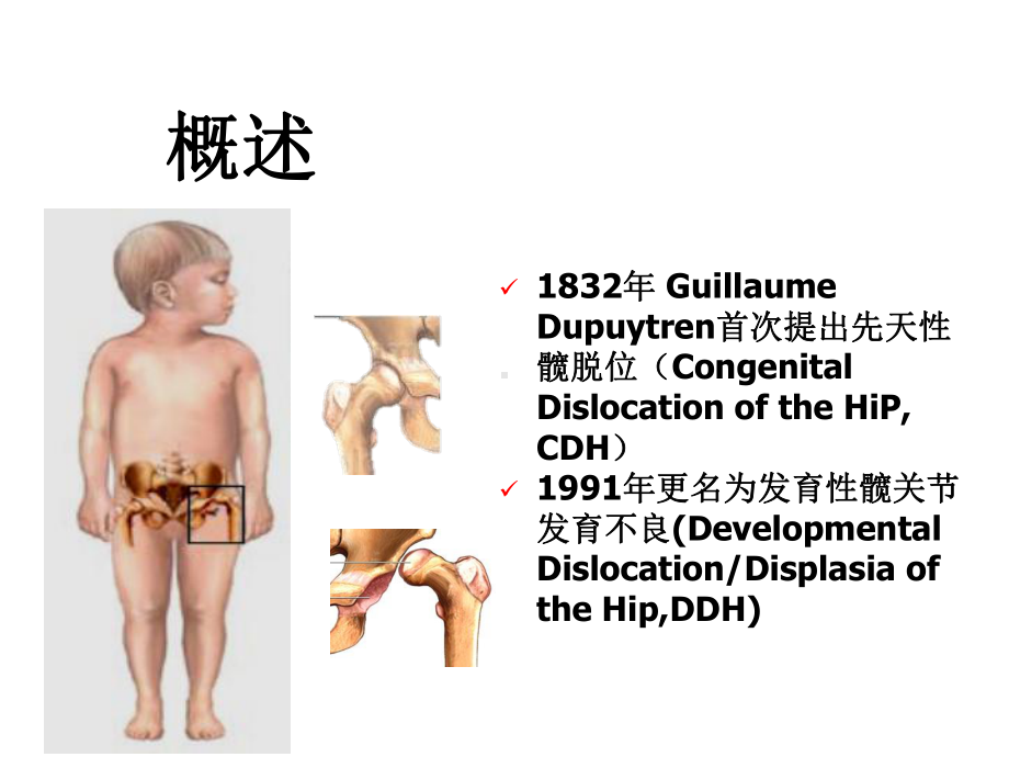 发育性髋关节发育不良髋脱位.ppt_第3页