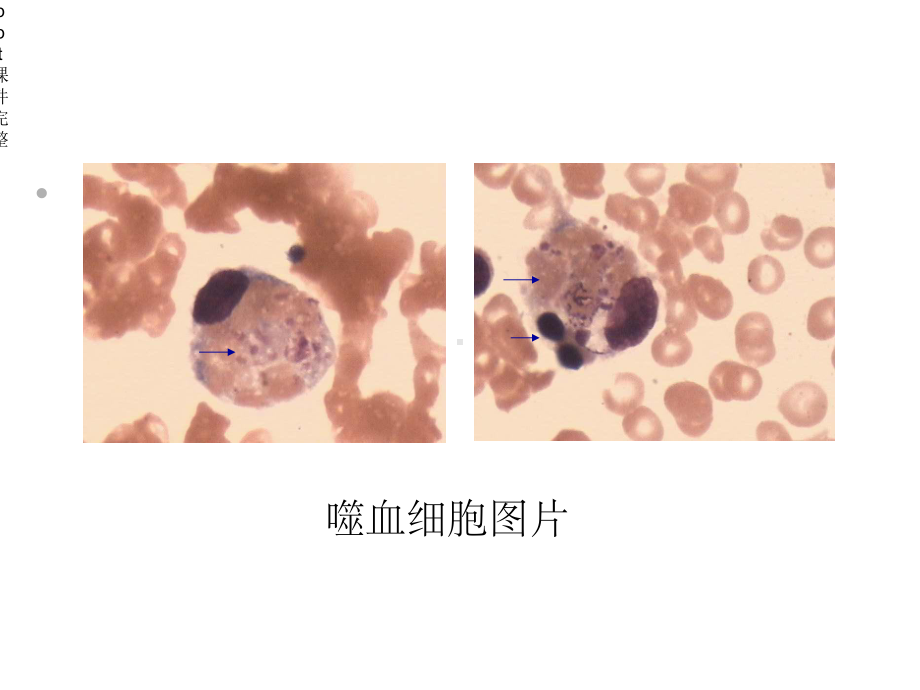 噬血细胞综合征HPS.ppt_第3页