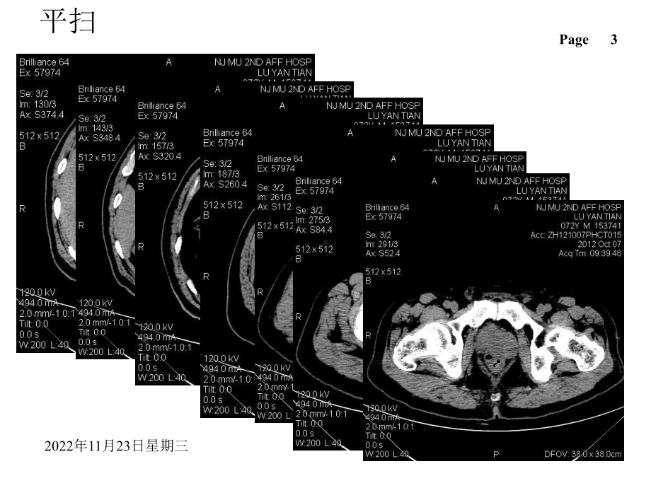 南京市读片-右肾占位.ppt_第3页