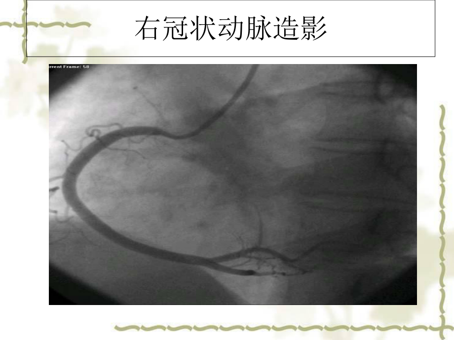 冠状动脉造影的护理.ppt_第3页