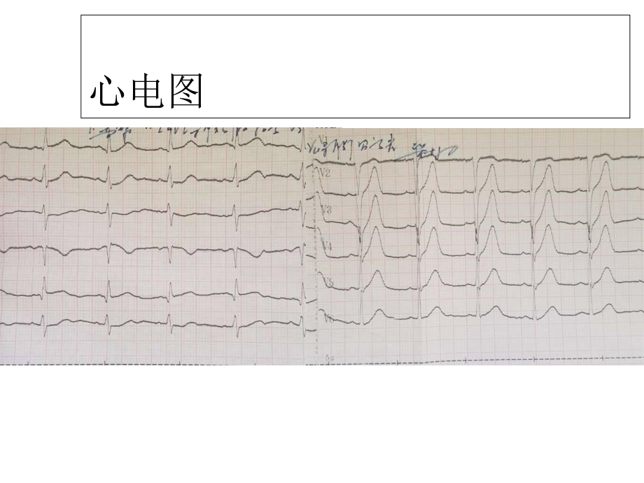 急诊PCI术后亚急性血栓两例.ppt_第3页