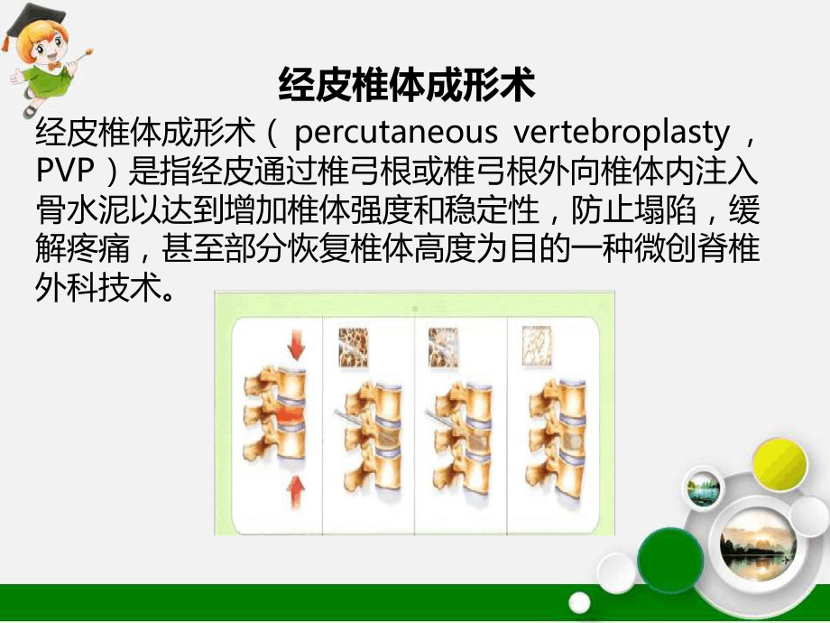 胸腰椎骨折的微创手术治疗课件.ppt_第3页