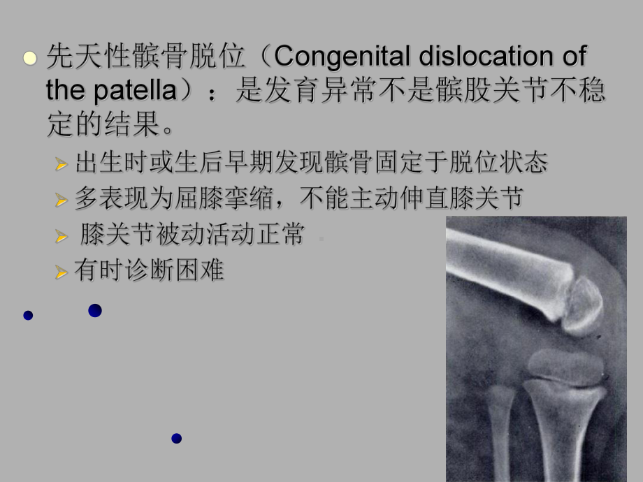 髌骨脱位课件.ppt_第3页