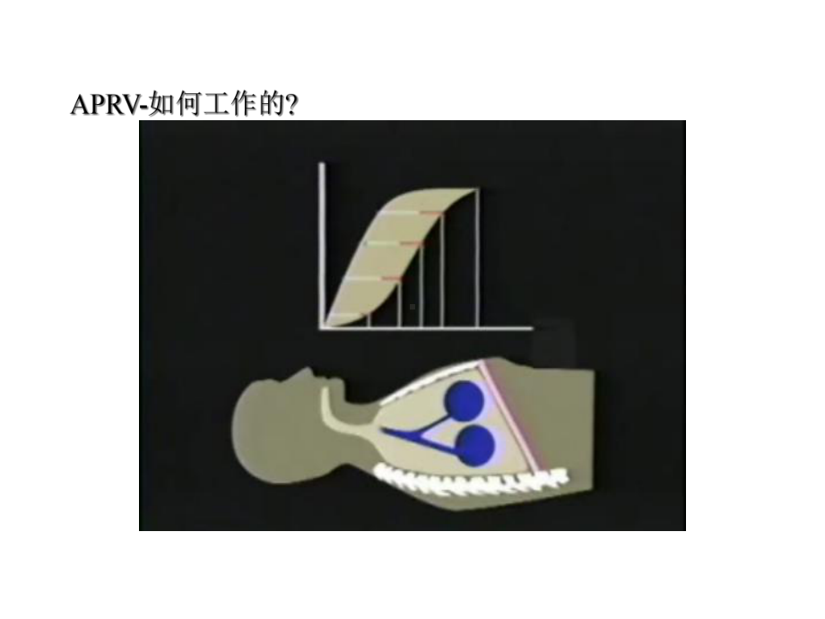 APRV气道压力释放通气.ppt_第3页