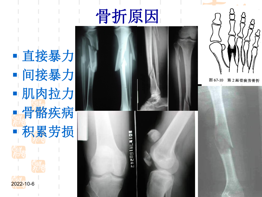 人卫九版骨科骨折概论课件(同名1286).ppt_第3页