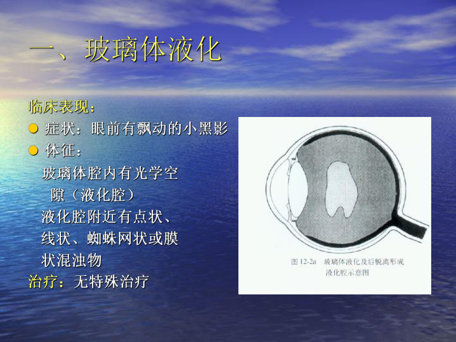 玻璃体疾病课件医学.ppt_第3页