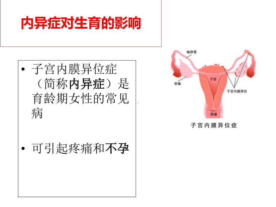 内膜异位合并不孕患者的生育力评估及处理原则.ppt_第3页