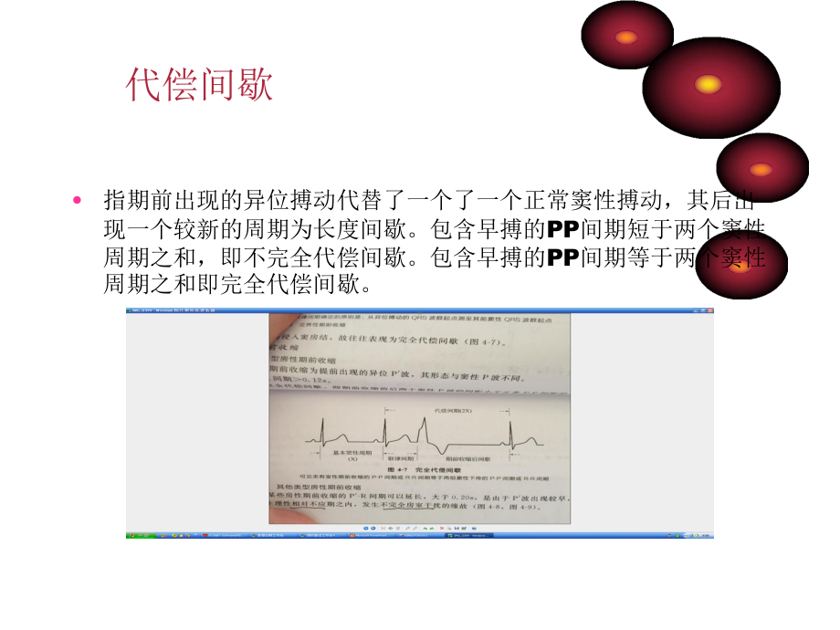 期前收缩课件.ppt_第3页