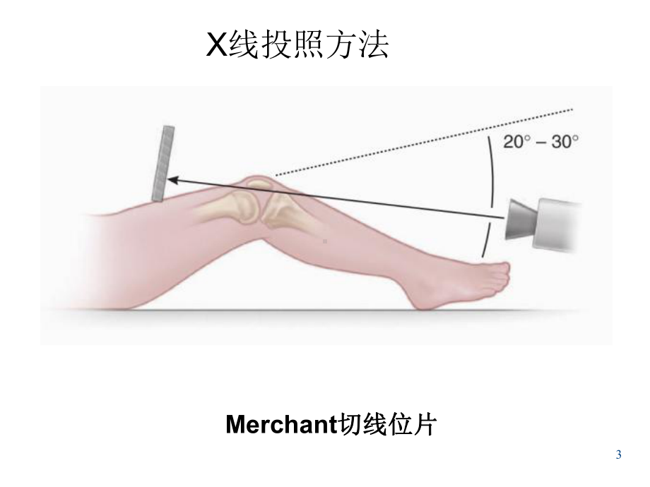 髌骨脱位精讲版课件.ppt_第3页