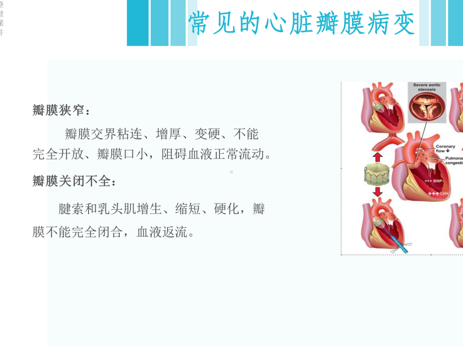 《风湿性心脏病》.ppt_第3页