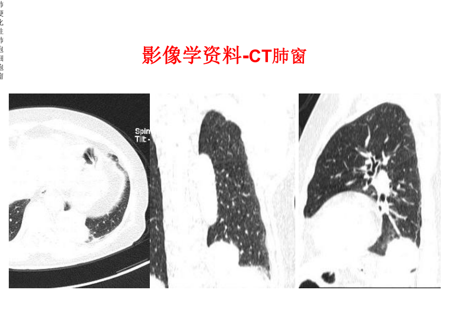 肺硬化性肺泡细胞瘤课件.ppt_第3页