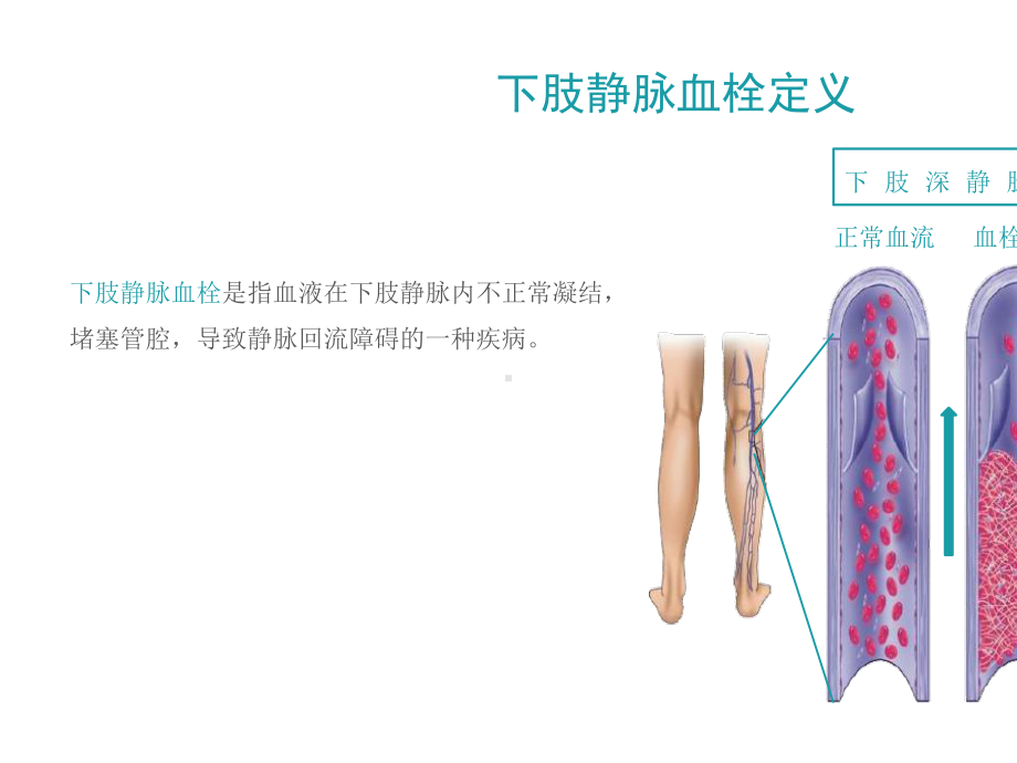 下肢静脉血栓查房.pptx_第2页