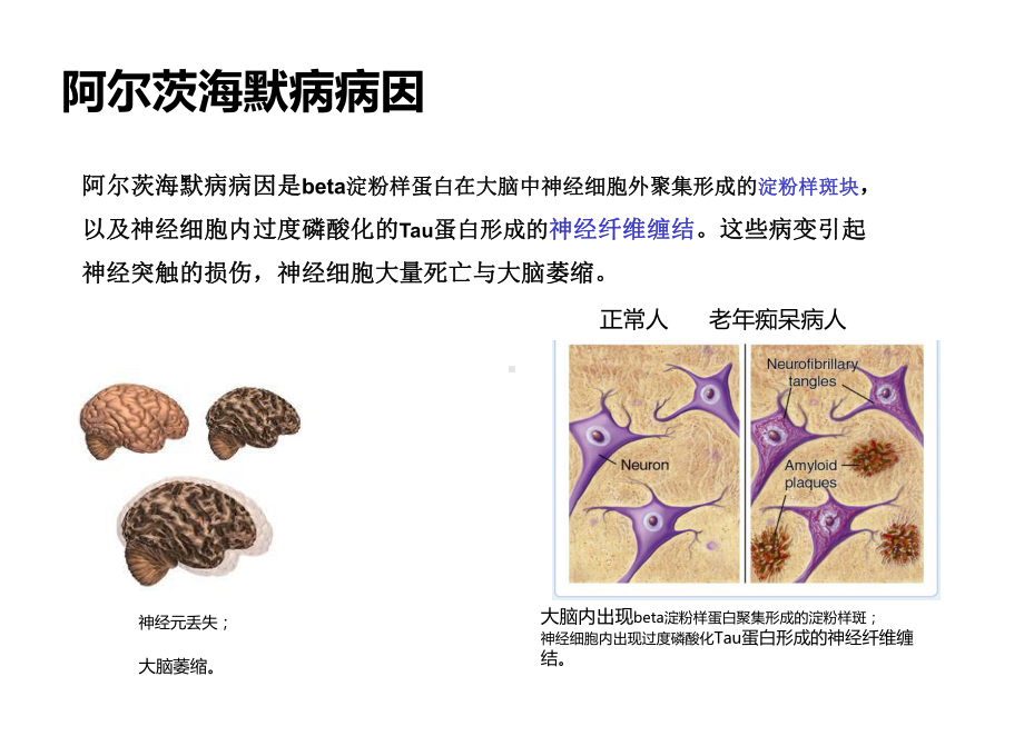 阿尔茨海默病(共22张)课件.pptx_第2页