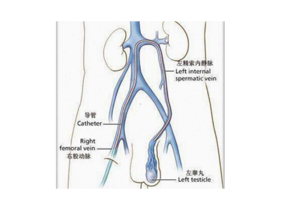 精索静脉曲张(共23张)课件.pptx_第3页