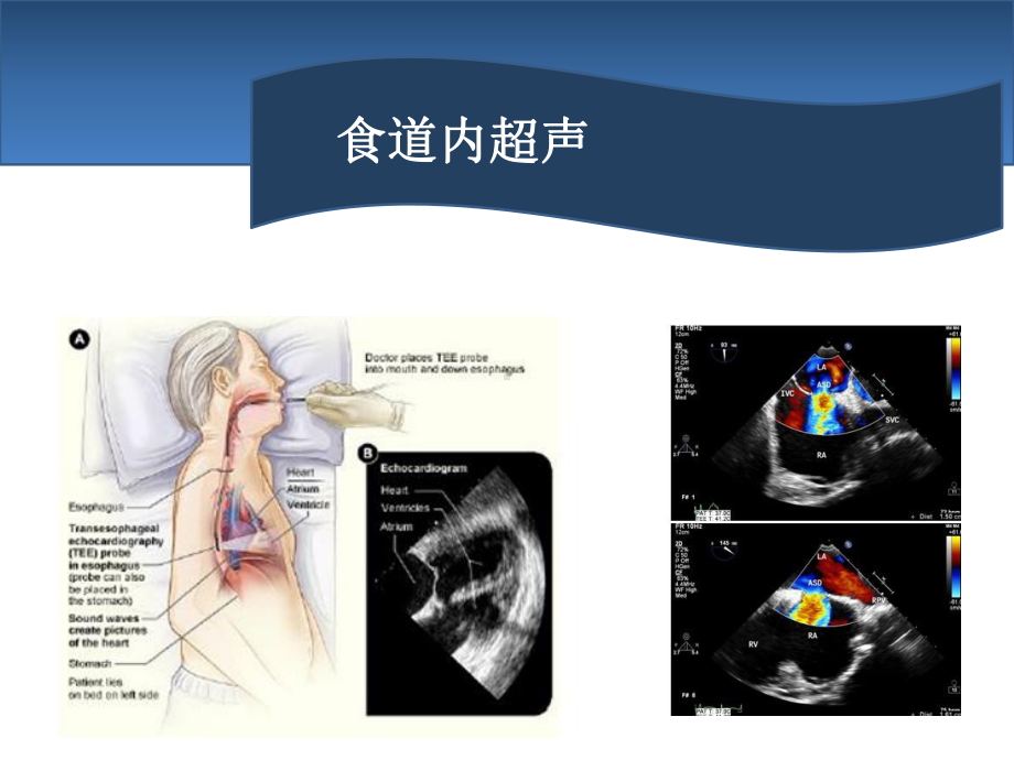 食道超声课件.ppt_第1页