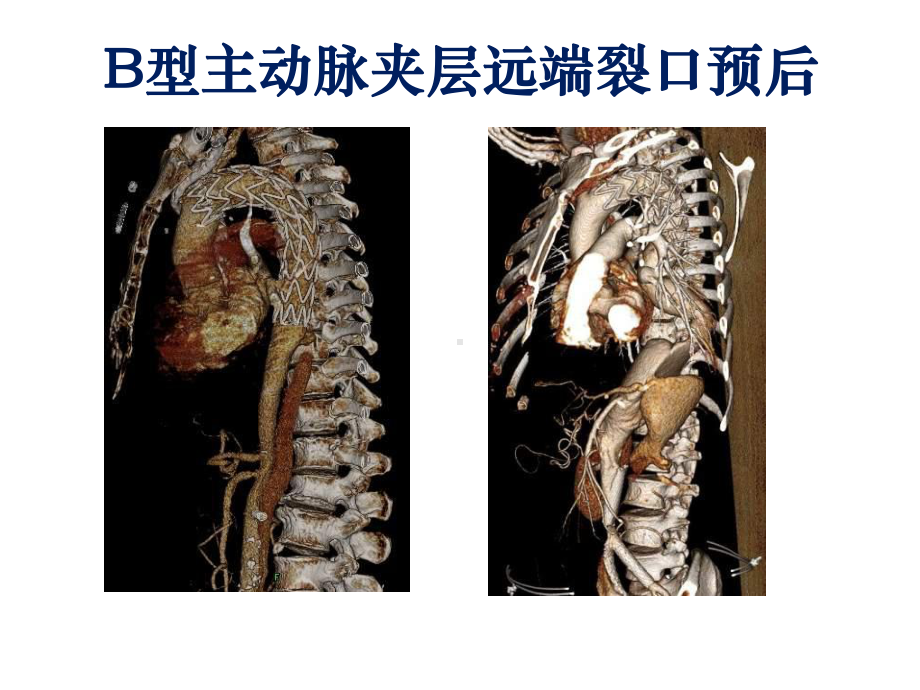 主动脉夹层远端裂口的挑战.ppt_第3页