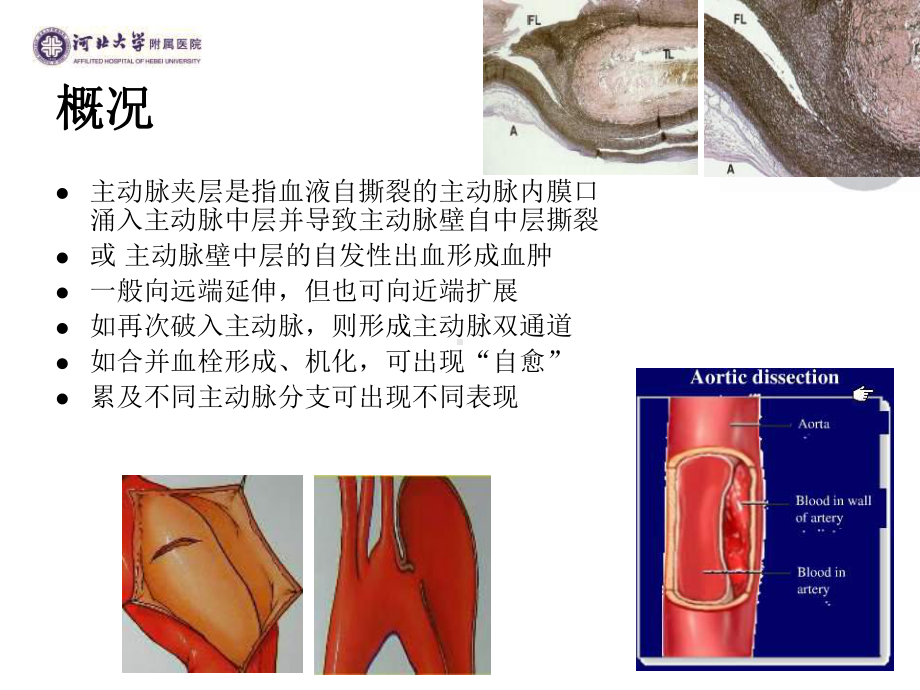 主动脉夹层的诊治医学.ppt_第2页